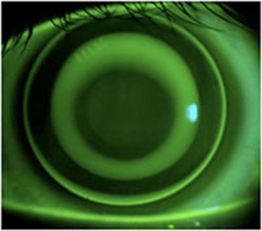 Improve Your Vision While You Sleep with Orthokeratology in Dubai Improve Your Vision While You Sleep with Orthokeratology in Dubai